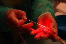 La thérapie photodynamique pour soigner le cancer