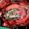 Exosquelette placé in vivo sur un cœur porcin Exosquelette placé in vivo sur un cœur porcin